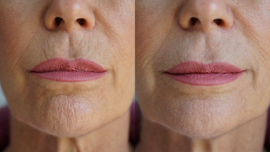 Close-up of a woman's lips before and after a cosmetic procedure.
