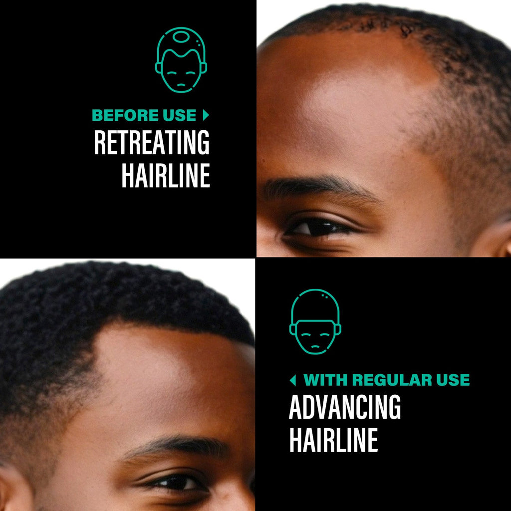 Before and after comparison of a hairline treatment showing retreating hairline before use and advancing hairline with regular use.